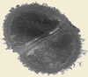 MRSA